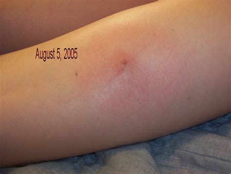 0001 | Early stage of a brown recluse spider bite. | Stacy McNabb | Flickr