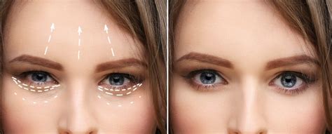 Image result for Thread Brow Lift Procedure