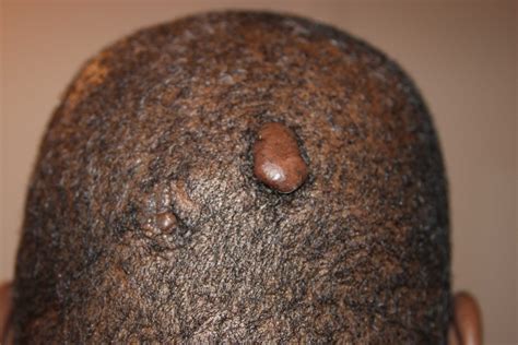 What Are Keloids And What Causes Them at Selma Burns blog