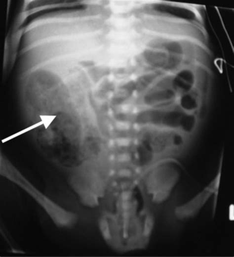 How to use abdominal X-rays in preterm infants suspected of developing ...