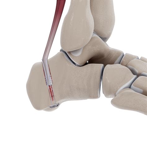 Chronic Achilles- FHL Tendon Transfer Knotless adjustable button - Dunamis Medical