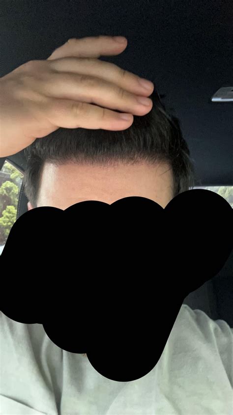 6 Months Today! Progress : r/HairTransplants