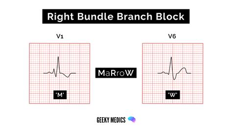 Left Bundle Branch Block Ecg