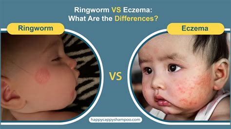 Ringworm VS Eczema: What Are the Differences? - Happy Cappy