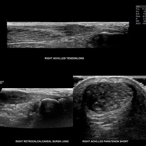 Tendonosis vs. Tendinitis