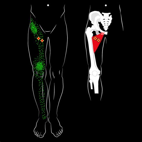 Adductor injuries - Hoppers Crossing Physiotherapy