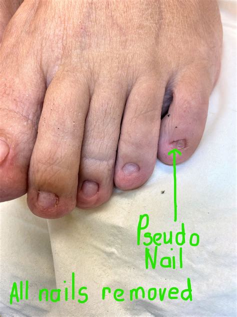 How To Treat A Damaged Nail Bed at Sienna Deeming blog