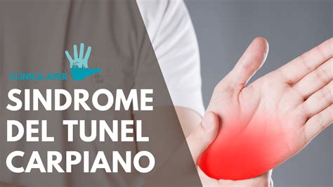 Sindrome del tunel carpiano - Clínica Afer