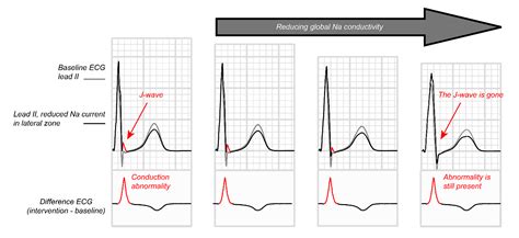 Repolarization Of The Heart