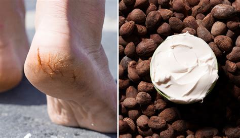 DIY Ways To Treat Cracked Heels at Home - lifeberrys.com