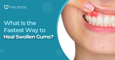 What Cures Inflamed Gums