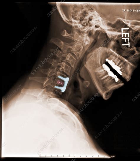 Image result for Spinal Fixation