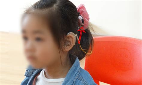 为什么人工耳蜗丢失后必须寻找，找回的价值更高? - 中国助听器行业网