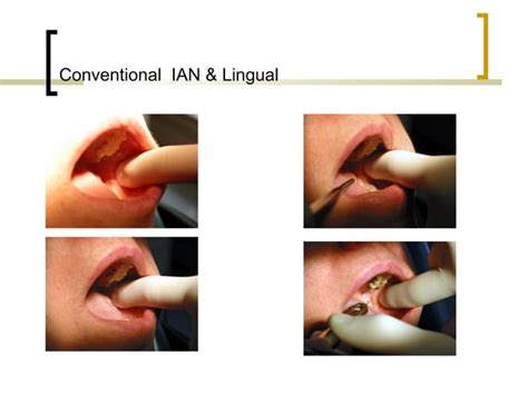 Local Anesthesia Injection 的图像结果