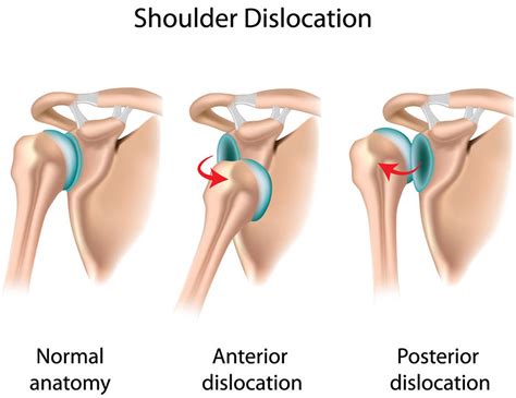 Dislocated Shoulder - Causes, Signs, Symptoms, How To Fix