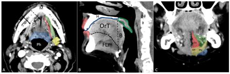 Floor Of Mouth Cancer Staging Radiology | Viewfloor.co