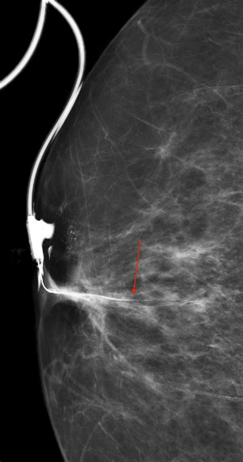 Imaging evaluation of nipple discharge: Review of literature and ...