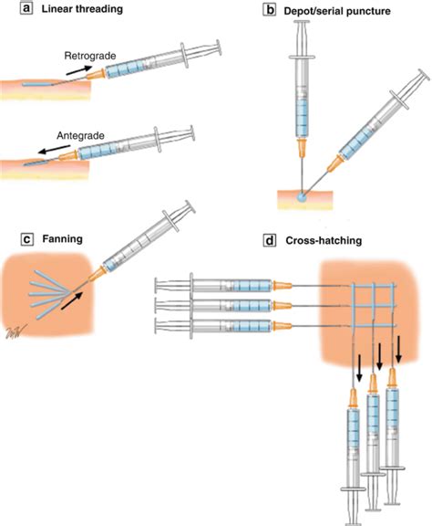 Image result for Injectable Pattern