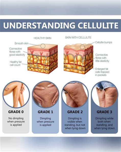 CELLULITE | JUVERNE