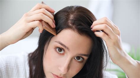 Itchy Scalp and Dandruff: Causes, Symptoms, and Treatment