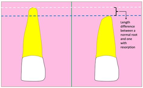 Root Resorption during Orthodontic Treatment with Clear Aligners vs ...