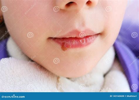 Herpes on Lips of Child. Treatment Ointment Stock Photo - Image of ...