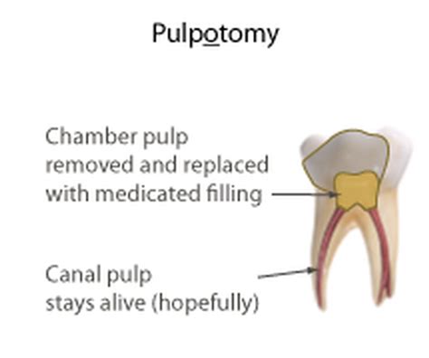 Image result for Pulp Extraction Tooth