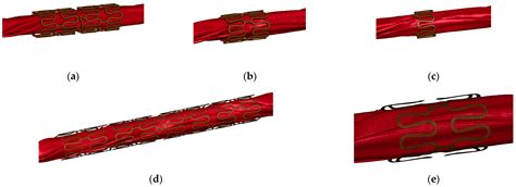 Simplified Models to Assess the Mechanical Performance Parameters of Stents