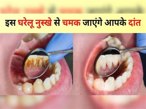 teeth whitening tips home remedies in hindi pile dant kaise saaf kare ...