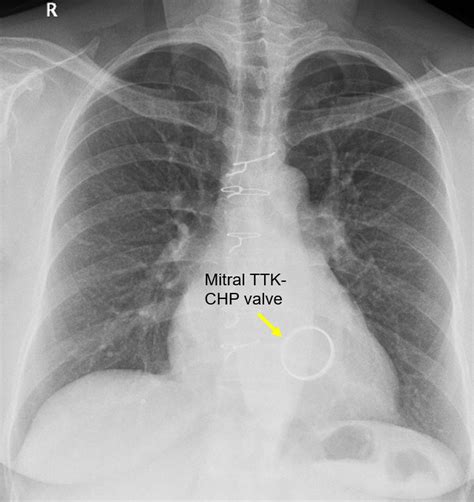 Heart Valve Replacement Xray