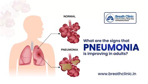 pneumonia who _ who pneumonia death rate – GJTU