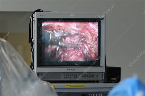 Actual Prostate Surgery 的图像结果