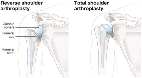 Reverse Shoulder Replacement Recovery