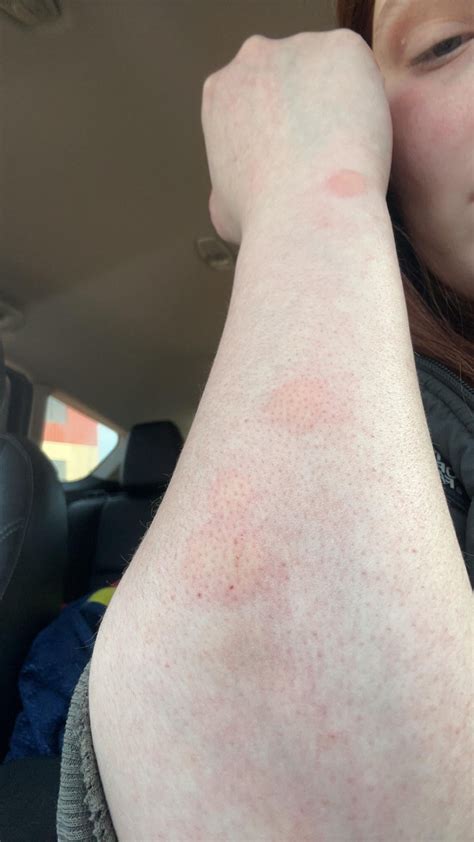 What is this itchy welts on my hands and arms? : r/DermatologyQuestions