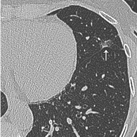 Updated Fleischner Society Guidelines for Managing Incidental Pulmonary ...