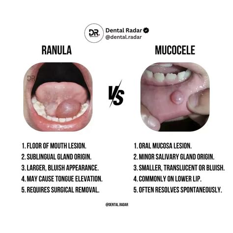 DentalRadar | Tooth infections, if left untreated, can lead to serious and potentially deadly ...