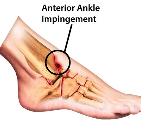 Anterior Ankle Impingement | Sportnova UK