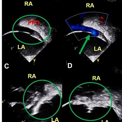 PFO Defect 的图像结果