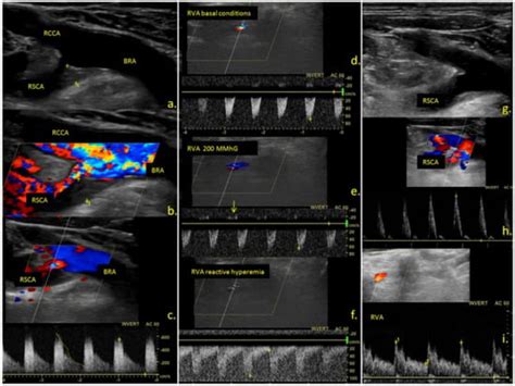 Prevalence and Clinical Characteristics of Subclavian Steal Phenomenon ...