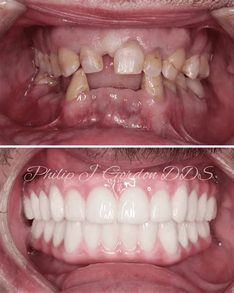 Honest Dental Implant Reviews & Patient Experiences