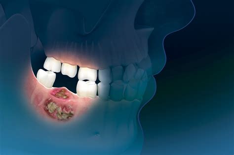Oral Bisphosphonates Linked to 6-Fold Increase in Risk for Osteonecrosis of the Jaw ...