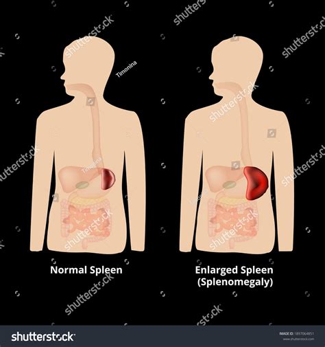Enlarged Spleen
