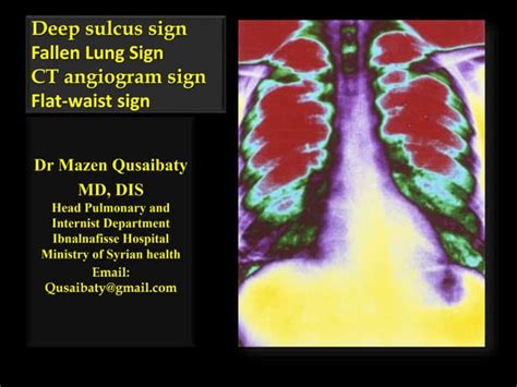 Image result for Step and Sulcus Sign