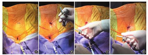 气腹穿刺置管技术在腰大池－腹腔分流术中的应用 - 中华神经外科杂志