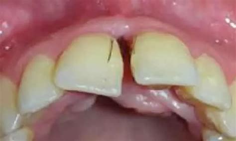 Rare case report of cyclosporine induced gingival hyperplasia
