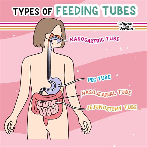 🍽️ TYPES OF FEEDING TUBES Feeding tubes are a lifeline for patients who ...