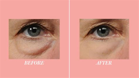 What Causes Bags Under Eyes Suddenly at Tamara Wilson blog