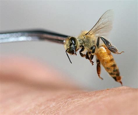 Bee Sting Acupuncture Allergic Reaction Kills Patient | Newsmax.com