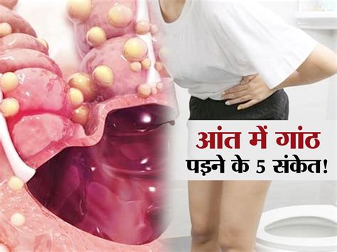 lump in Gut : आंतों में पड़ गई हैं गांठ बताते हैं ये 5 संकेत ...