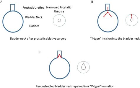 Bladder Neck Contracture